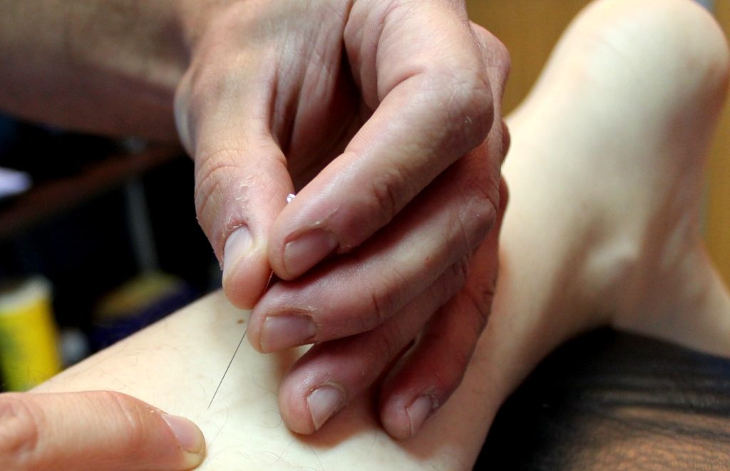 Diagrama de puntos de acupuntura para fascitis plantar
